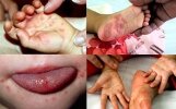 Những điều cần biết khi trẻ nhỏ mắc bệnh chân tay miệng