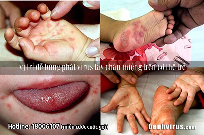 Những vị trí virus tay chân miệng dễ bùng phát trên cơ thể trẻ