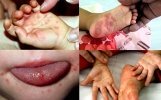 Những thông tin khi trẻ nhỏ mắc bệnh chân tay miệng
