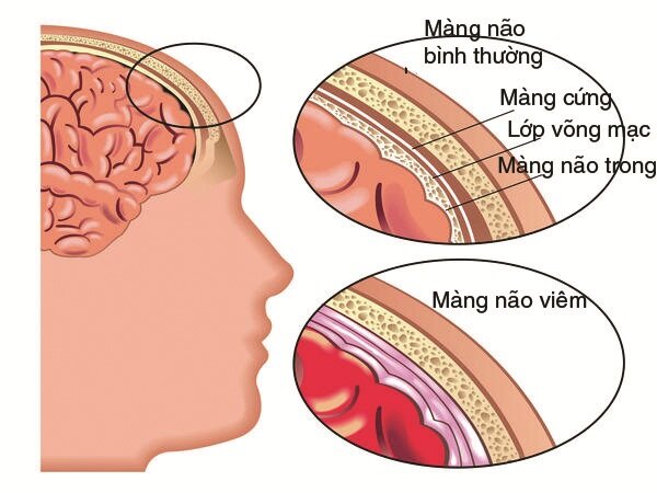 viêm màng não là biến chứng của thủy đậu